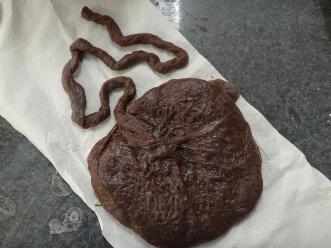 Nach der Geburt ihres Kindes hat Johanna die Plazenta in die Tiefkühltruhe gelegt, um diese dann später in Wachs zu gießen.