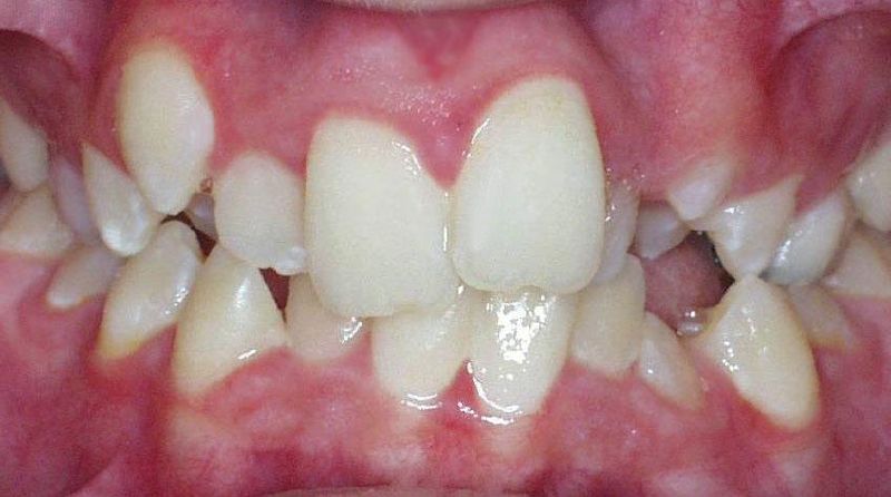 File:Teeth1.jpeg
